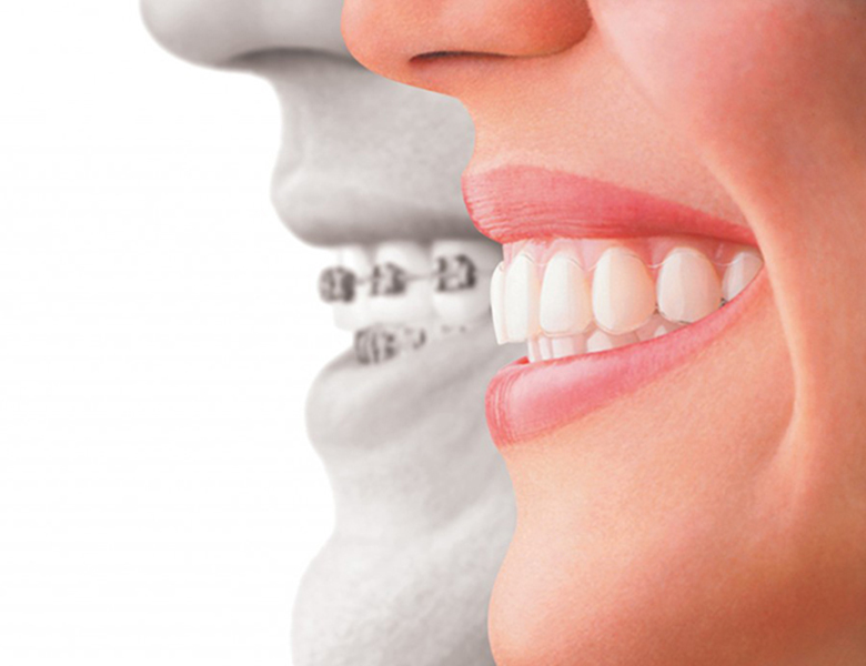 シュアスマイル矯正