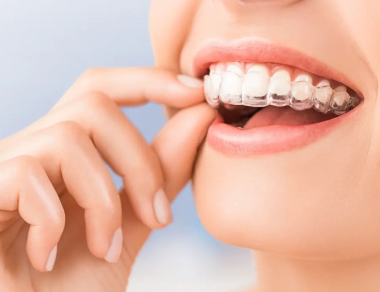 シュアスマイル矯正