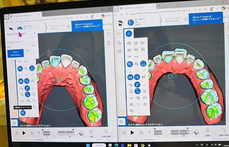 シュアスマイル矯正