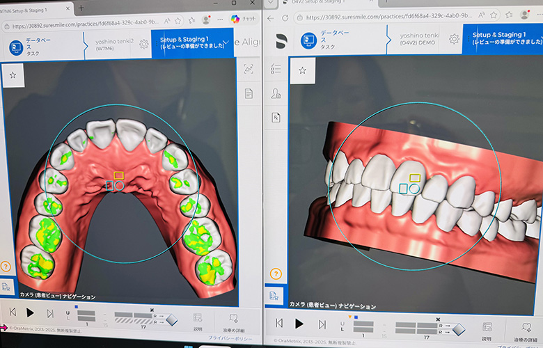 シュアスマイル矯正
