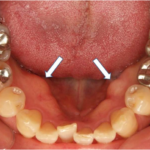 新宿（大久保駅）の歯医者、橋本歯科医院で下顎隆起（骨隆起）について解説