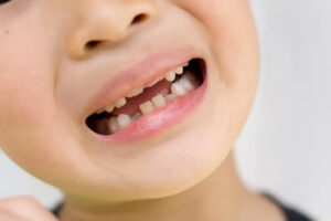 新宿（大久保駅）の歯医者、橋本歯科医院で子どもの歯ぎしりについて解説