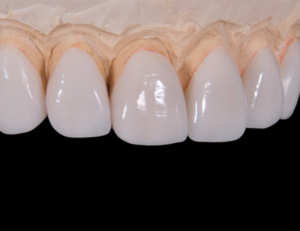 新宿（大久保駅）の歯医者、橋本歯科医院でマイクロスコープを使った精密治療のメリットと治療例を解説