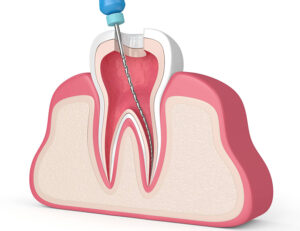 新宿（大久保駅）の歯医者、橋本歯科医院でマイクロスコープを使った精密治療のメリットと治療例を解説