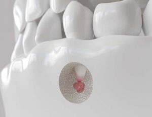 新宿（大久保駅）の歯医者、橋本歯科医院でマイクロスコープを使った精密治療のメリットと治療例を解説