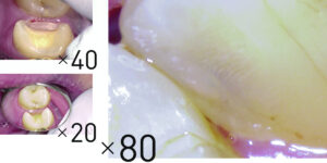 新宿（大久保駅）の歯医者、橋本歯科医院でマイクロスコープを使った精密治療のメリットと治療例を解説