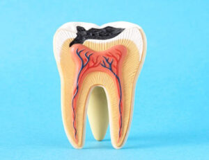 新宿（大久保駅）の歯医者、橋本歯科医院でマイクロスコープを使った精密治療のメリットと治療例を解説