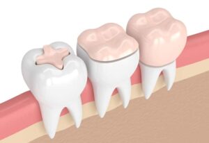 新宿（大久保駅）の歯医者、橋本歯科医院で、痛みのなかった歯が治療後に痛くなった原因についての解説