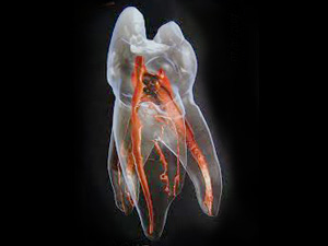 新宿（大久保駅）の歯医者、橋本歯科医院で、痛みのなかった歯が治療後に痛くなった原因についての解説