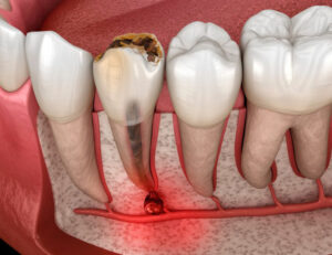 新宿（大久保駅）の歯医者、橋本歯科医院で、痛みのなかった歯が治療後に痛くなった原因についての解説